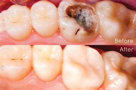 ADA NSW - Direct and Indirect Resin Composite Restorations