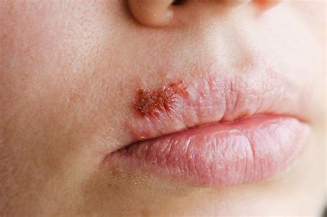 Simplex Herpes Lips at Gary Winter blog