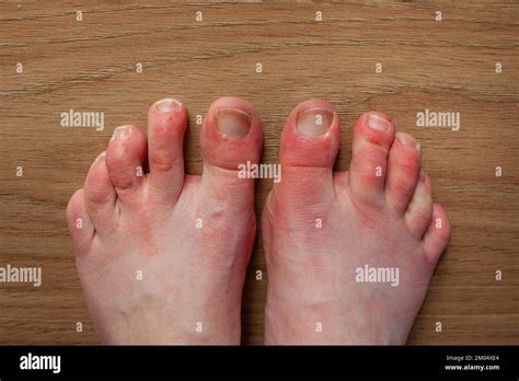 Feet of person with Raynaud's phenomenon and chilblains lesions on toes Chilblains red, swollen ...