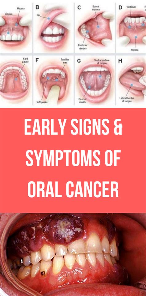 Early Signs & Symptoms of Oral Cancer - Alorabarbie