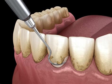 Scaling and Root Planing - Keys Dental Specialists