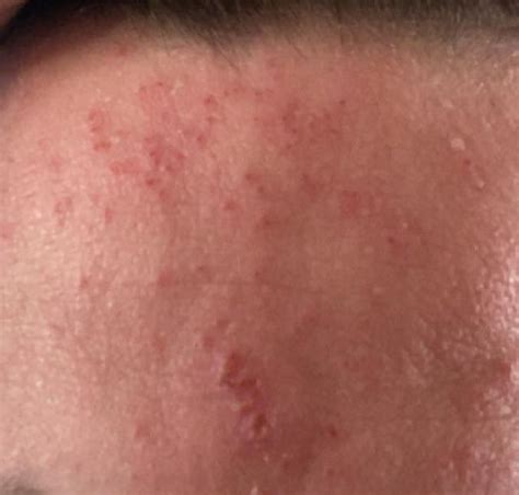 strange rash on forehead, got a day ago and now not sure what it is or what to do : r ...