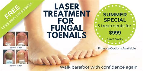 Fungal Nail Infection Treatment Laser | Foot Mechanics New Zealand