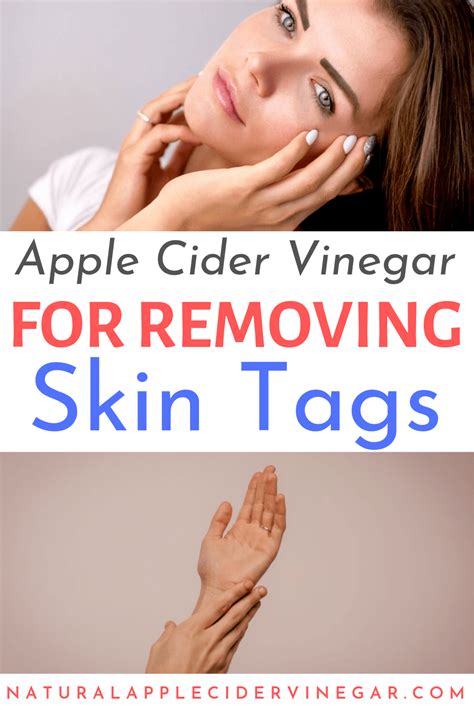 How to Use Apple Cider Vinegar to Remove Skin Tags | Skin tag removal ...