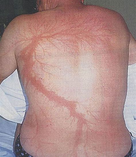 Scars after a lightning strike : r/creepy