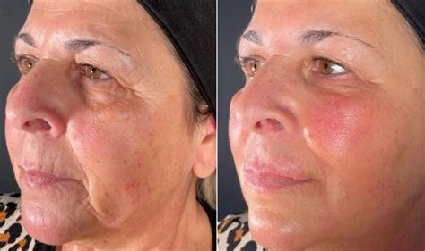 How to look younger: 60-year-old 'feels alive' again after facial ...