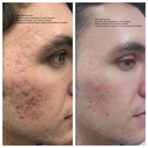 Acne Scar Laser Treatment & Removal London | Dr H Consult