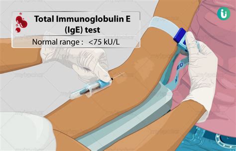 टोटल इम्युनोग्लोबुलिन ई (आईजीई) टेस्ट क्या है, खर्च, कब, क्यों, कैसे होता है - Total ...