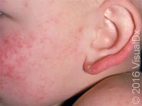 Viral Rash In Children Face