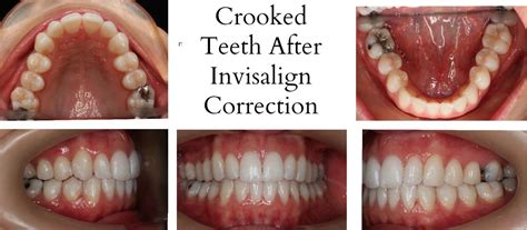 Mothlhtqqjbpqdp: Invisalign Before And After Crooked Teeth