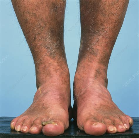 Varicose vein bruising - Stock Image - M290/0147 - Science Photo Library