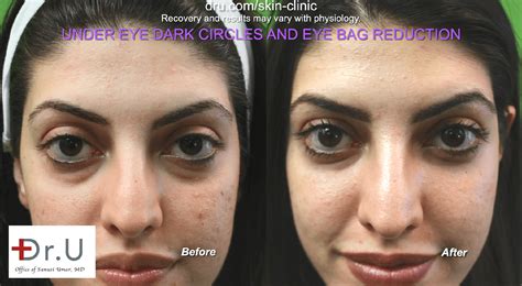 Video - Dark Circles and Eye Bags: Non-Surgical Eye Bag Reduction