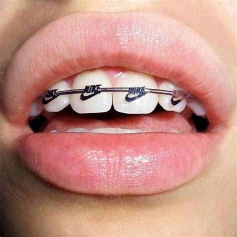 Pin by Marum Haal on Nike | Cute braces, Braces colors, Braces girls