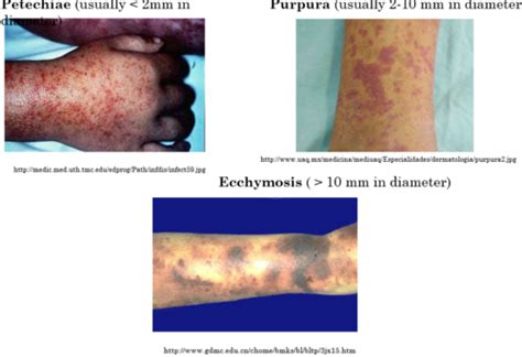 Ecchymosis Vs Petechiae