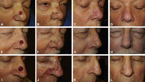 The superiorly based bilobed flap for nasal reconstruction - Journal of ...