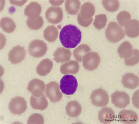 Follicular Lymphoma - LearnHaem | Haematology Made Simple