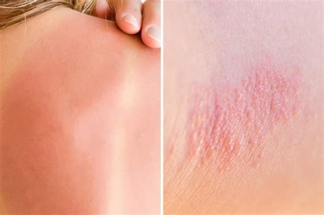 Can Heat Cause A Rash at Christine Zeringue blog