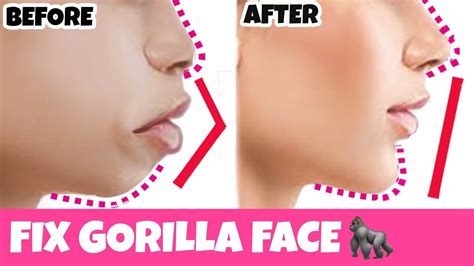 Get a Perfect Profile! Get Rid Of Protruding Mouth, Lips | Get High Nose, Beautiful Chin, Small ...