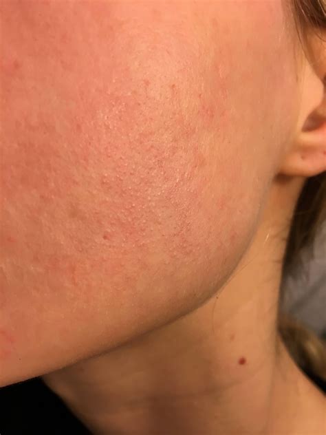 Cystic Acne On Neck And Jawline - babyacnearticles