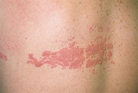 Shingles as related to Skin - Pictures