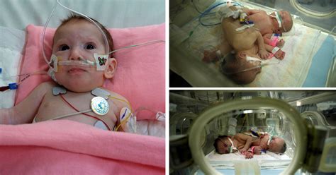 Surgeons successfully separate baby boy from 'parasitic conjoined twin' | Metro News