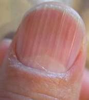 Ridges in Fingernails | New Health Guide