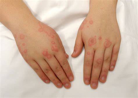 Mastocytosis Systemic Rash