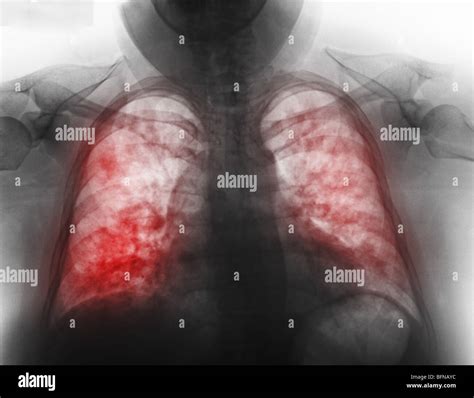 Abnormal chest x-ray showing pneumonia in a 27 year old female with Stock Photo: 26899808 - Alamy