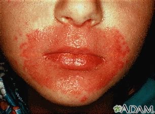 Candida infection of the skin Information | Mount Sinai - New York