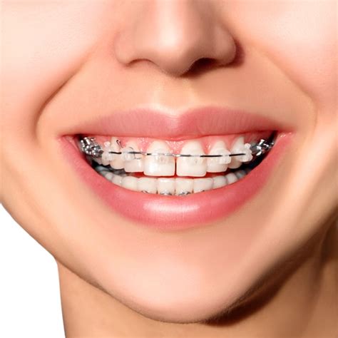 Is There a Best Material For Braces? | Orthodontic Associates