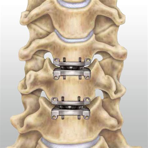 Neck disc surgery in Iran at Erfan Hospital - irantreatments - Plastic ...