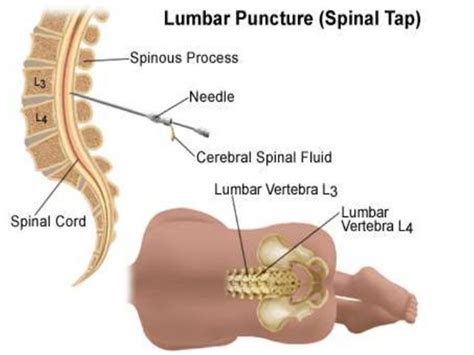 Lumbar puncture