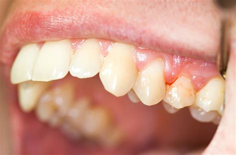 Common Causes of Bleeding Gums - Paducah Dentist