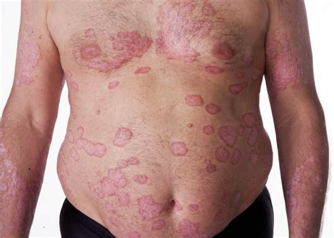 What Triggers Psoriasis And Causes It To Flare?