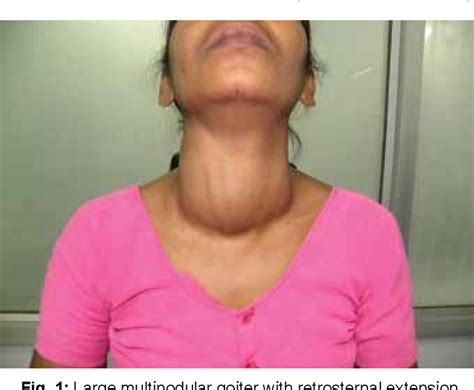 Figure 1 from Pemberton Sign in Diagnosis of Retrosternal Goiter ...