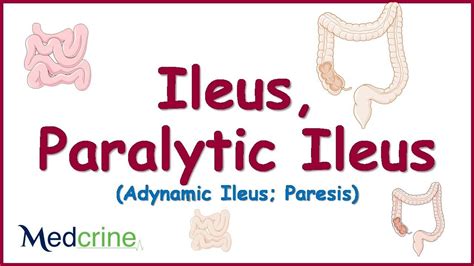 Paralytic Ileus : causes, pathophysiology, clinical features, diagnosis ... | Diagnosis ...