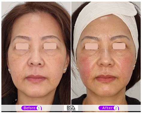 HIFU Treatment Sydney – Before & After, Side Effects + Cost