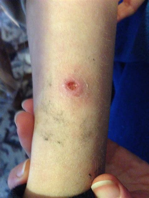 Brown Recluse Spider Bite! - Ridge Haven Homestead