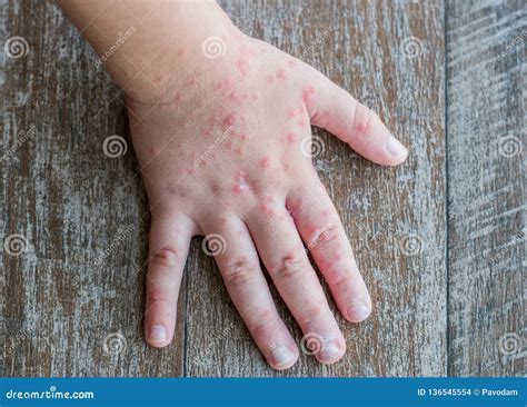 Coxsackie Virus. Child With A Skin Rash. Stock Photography ...