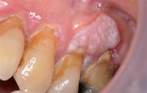 Oral Lichen Planus - Causes, Symptoms, Prognosis, Diagnosis, Treatment