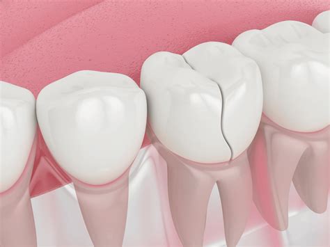 Cracked Tooth Causes, Symptoms, and Treatment - All Smiles Care