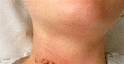 photo of a #ACDF Scar 24-hours after #surgery cervical herniated disc removed during #ACDF ...