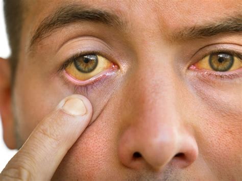 High Cholesterol Symptoms: These 7 Signs In Eyes Can Tell If You Have High Cholesterol ...