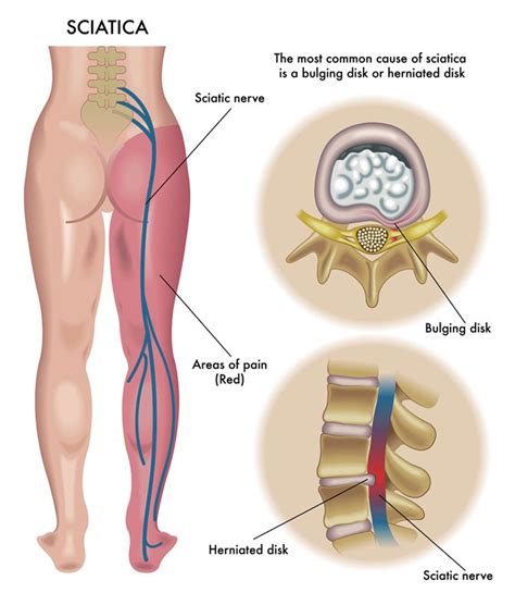 Sciatica (Pinched Nerve) Causes, Symptoms & Treatments