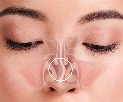 Deviated Nasal Septum: Meaning, Types, Causes, Symptoms, & Treatment