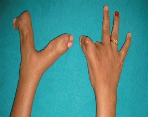 Ectodermal Dysplasia Hands