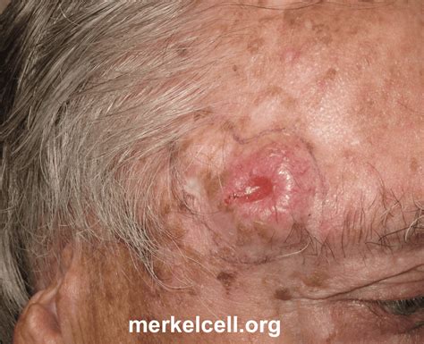 Clinical Photos of Merkel Cell Carcinoma