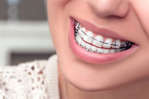 Clear Ceramic Braces Wahroonga | Wahroonga Family Dental Centre