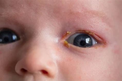 Eye Boogers: Types, Causes & How to Get Rid of Them | MyVision.org