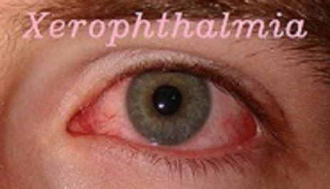 Diagnosis Of Xerophthalmia By Vital Staining Sauter, 1976, 41% OFF